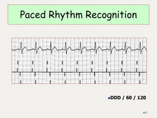 Paced Rhythm Recognition
DDD / 60 / 120
22
 