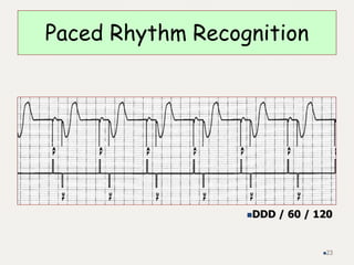 Paced Rhythm Recognition
DDD / 60 / 120
23
 