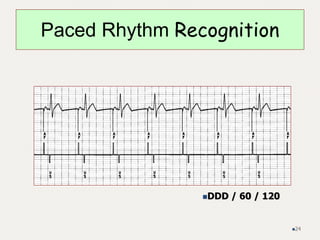Paced Rhythm Recognition
DDD / 60 / 120
24
 