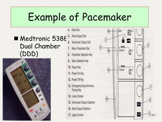 Example of Pacemaker
 Medtronic 5388
Dual Chamber
(DDD)
33
 