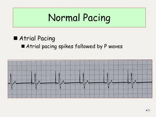 Normal Pacing
 Atrial Pacing
 Atrial pacing spikes followed by P waves
36
 
