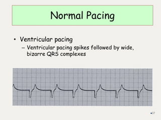 Normal Pacing
• Ventricular pacing
– Ventricular pacing spikes followed by wide,
bizarre QRS complexes
37
 