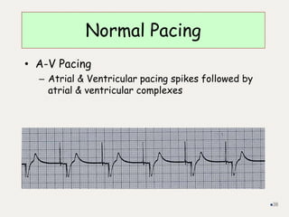 Normal Pacing
• A-V Pacing
– Atrial & Ventricular pacing spikes followed by
atrial & ventricular complexes
38
 