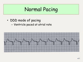 Normal Pacing
• DDD mode of pacing
– Ventricle paced at atrial rate
39
 