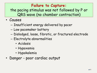 Failure to Capture:
the pacing stimulus was not followed by P or
QRS wave (no chamber contraction)
• Causes
– Insufficient energy delivered by pacer
– Low pacemaker battery
– Dislodged, loose, fibrotic, or fractured electrode
– Electrolyte abnormalities
• Acidosis
• Hypoxemia
• Hypokalemia
• Danger - poor cardiac output
44
 