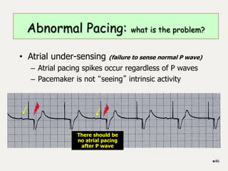 • Atrial under-sensing (failure to sense normal P wave)
– Atrial pacing spikes occur regardless of P waves
– Pacemaker is not “seeing” intrinsic activity
46
Abnormal Pacing: what is the problem?
There should be
no atrial pacing
after P wave
 