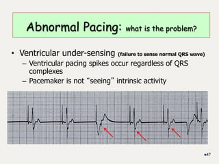 • Ventricular under-sensing (failure to sense normal QRS wave)
– Ventricular pacing spikes occur regardless of QRS
complexes
– Pacemaker is not “seeing” intrinsic activity
47
Abnormal Pacing: what is the problem?
 
