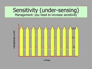 
Amplitude
(mV)
Time
5.0
2.5
1.25
Sensitivity (under-sensing)
Management: you need to increase sensitivity
 