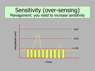 
Amplitude
(mV)
Time
5.0
2.5
1.25
Sensitivity (over-sensing)
Management: you need to increase sensitivity
 