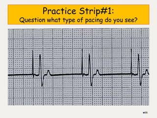 Practice Strip#1:
Question what type of pacing do you see?
66
 