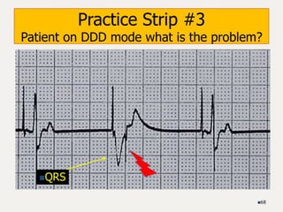 Practice Strip #3
Patient on DDD mode what is the problem?
68
QRS
 