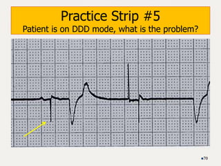 Practice Strip #5
Patient is on DDD mode, what is the problem?
70
 