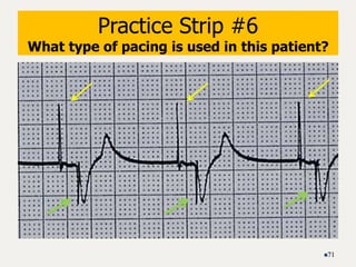 Practice Strip #6
What type of pacing is used in this patient?
71
 