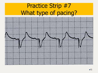 Practice Strip #7
What type of pacing?
72
 