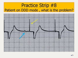 Practice Strip #8
Patient on DDD mode , what is the problem?
73
 