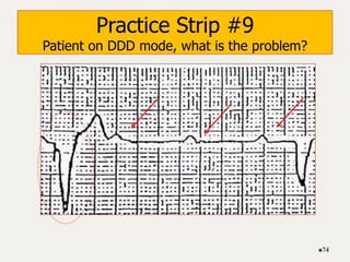 Practice Strip #9
Patient on DDD mode, what is the problem?
74
 