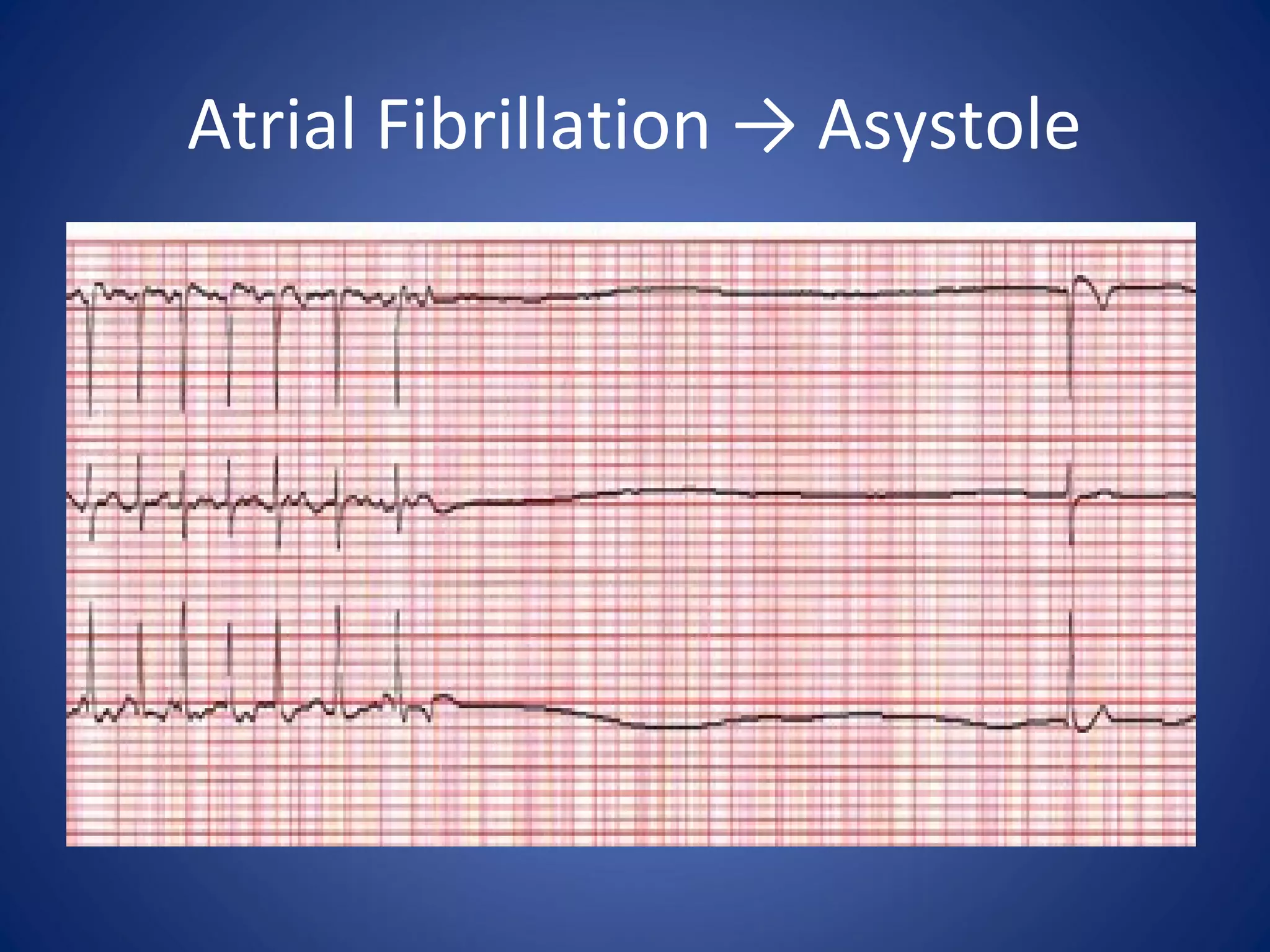 Atrial Fibrillation → Asystole
 
