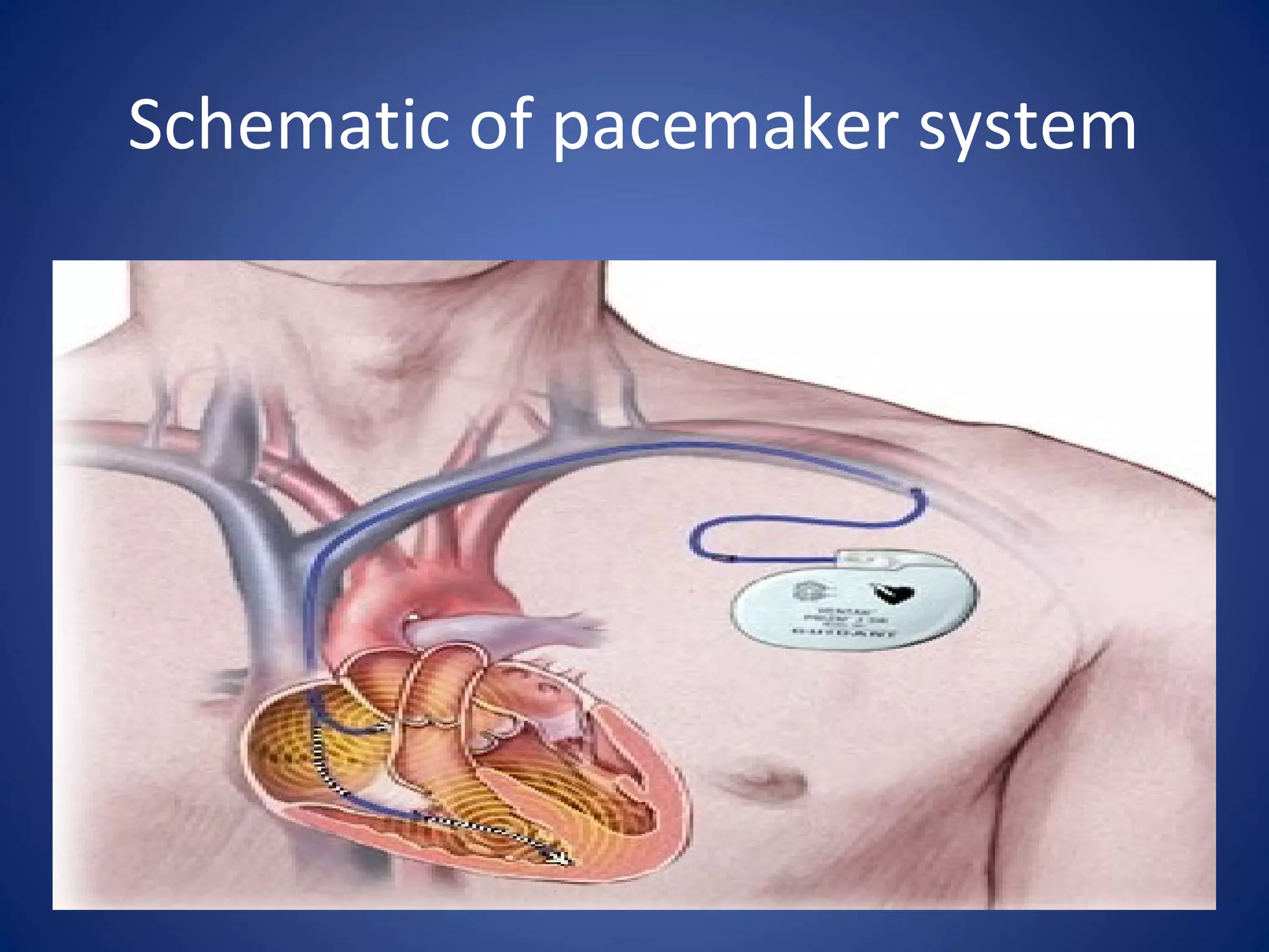 Schematic of pacemaker system
 