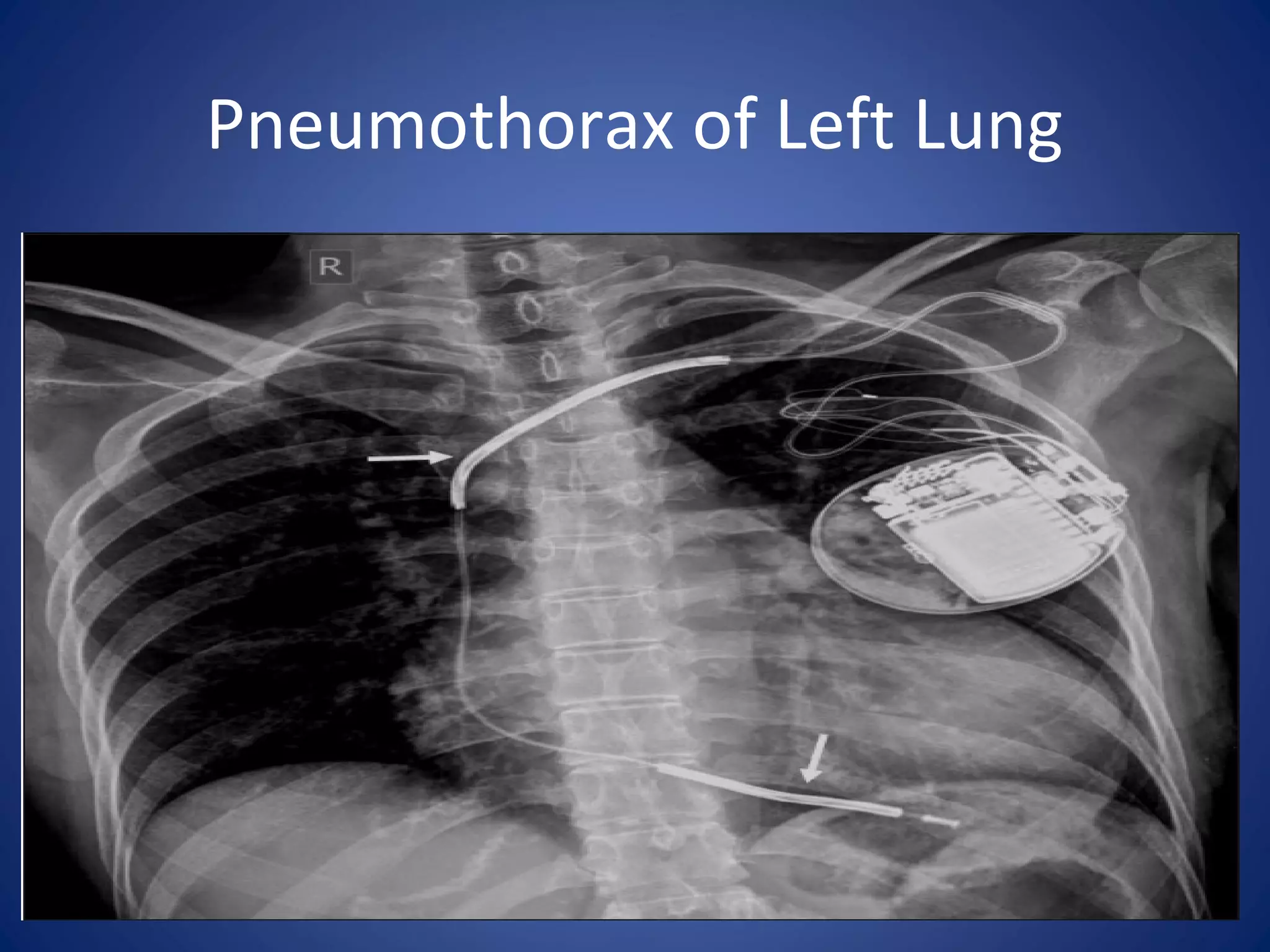 Pneumothorax of Left Lung
 
