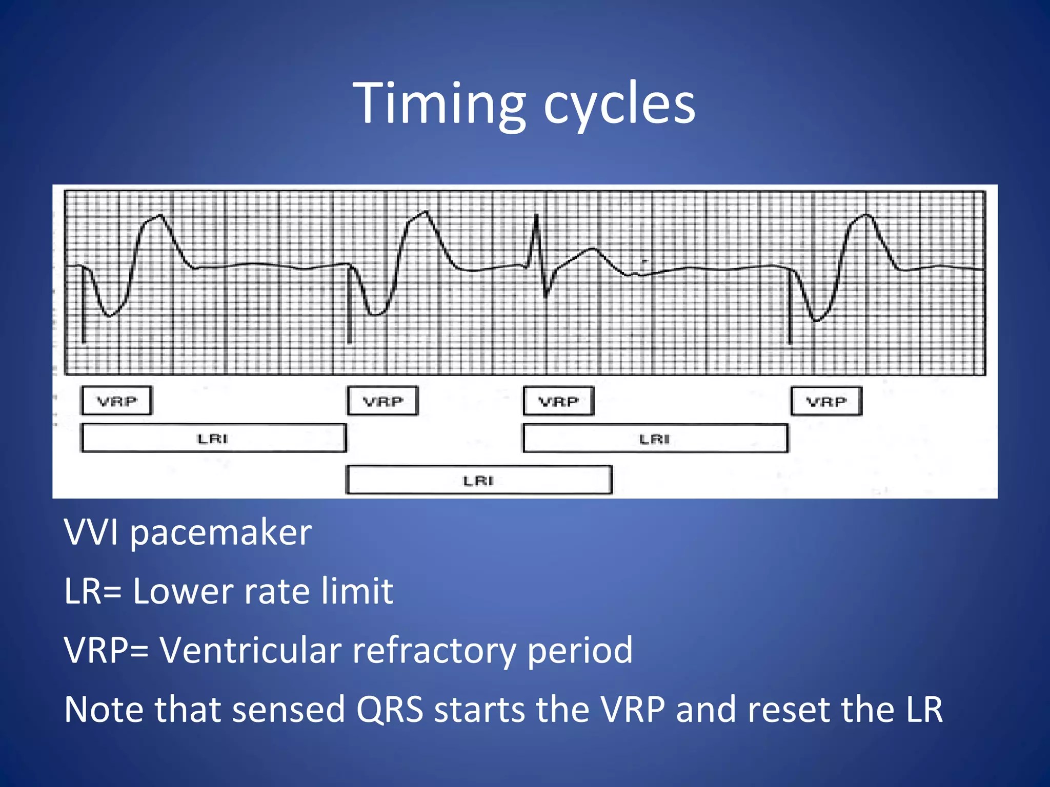 Timing cycles
VVI pacemaker
LR= Lower rate limit
VRP= Ventricular refractory period
Note that sensed QRS starts the VRP and reset the LR
 