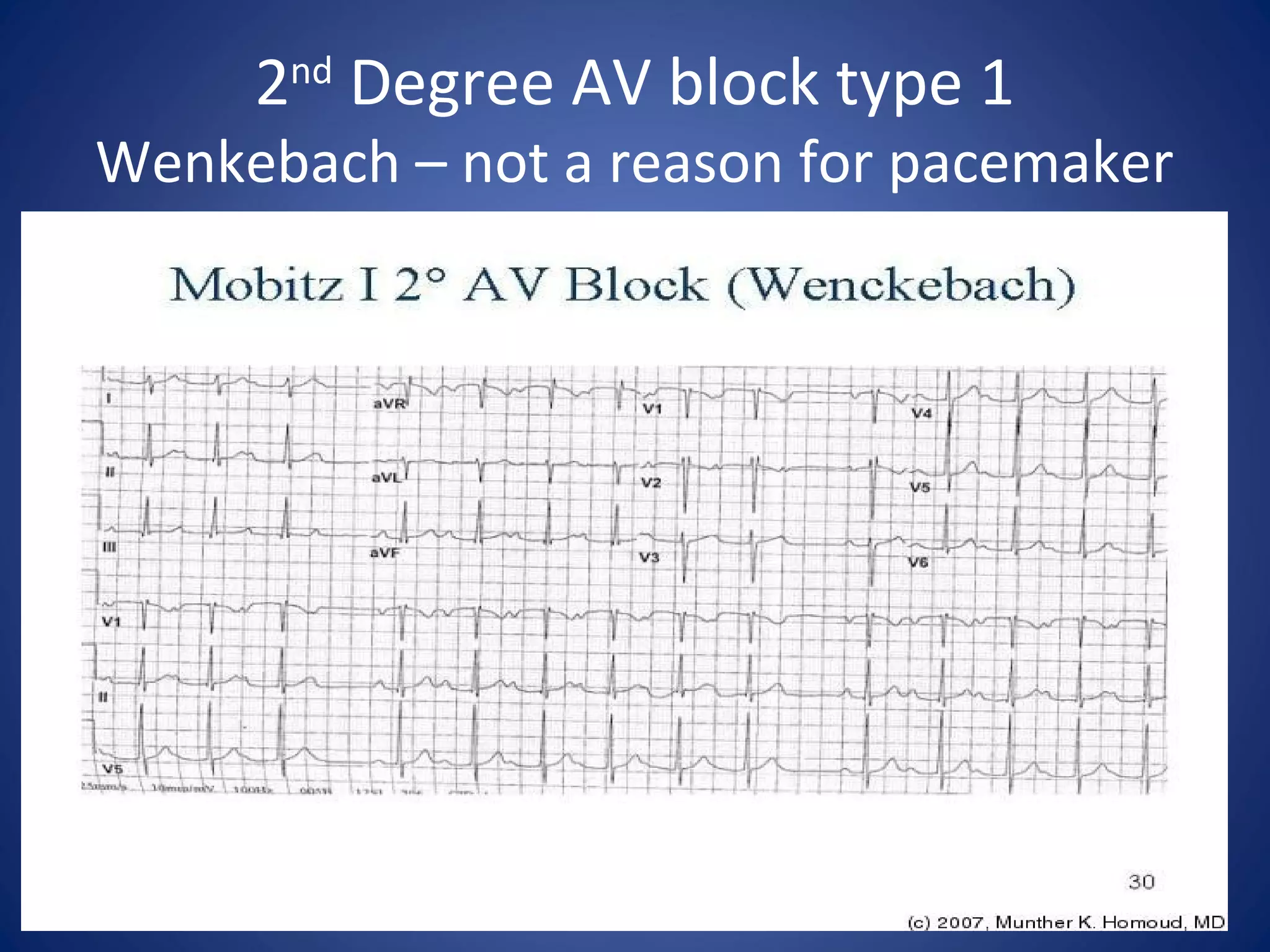 2nd
Degree AV block type 1
Wenkebach – not a reason for pacemaker
 