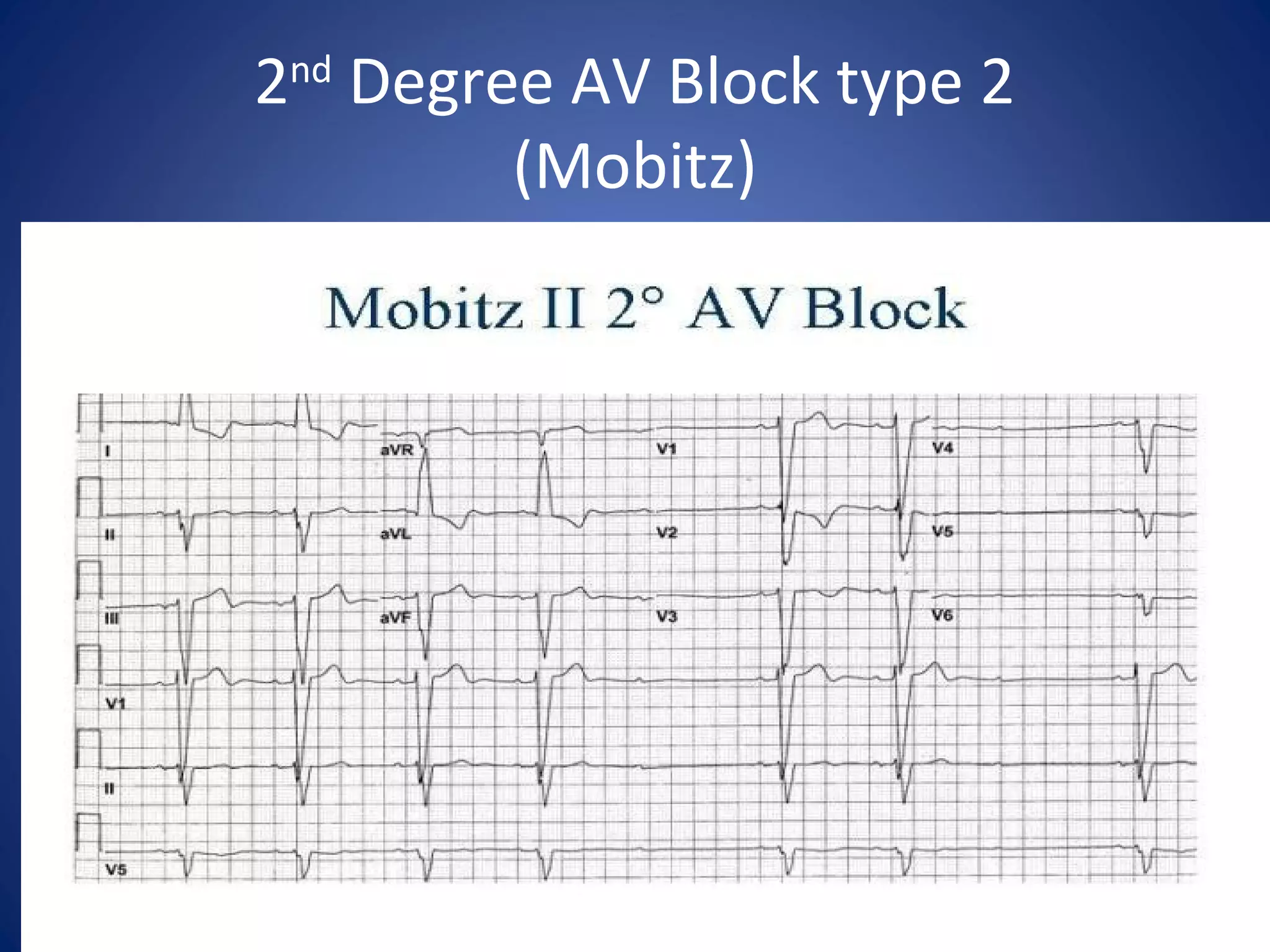 2nd
Degree AV Block type 2
(Mobitz)
 