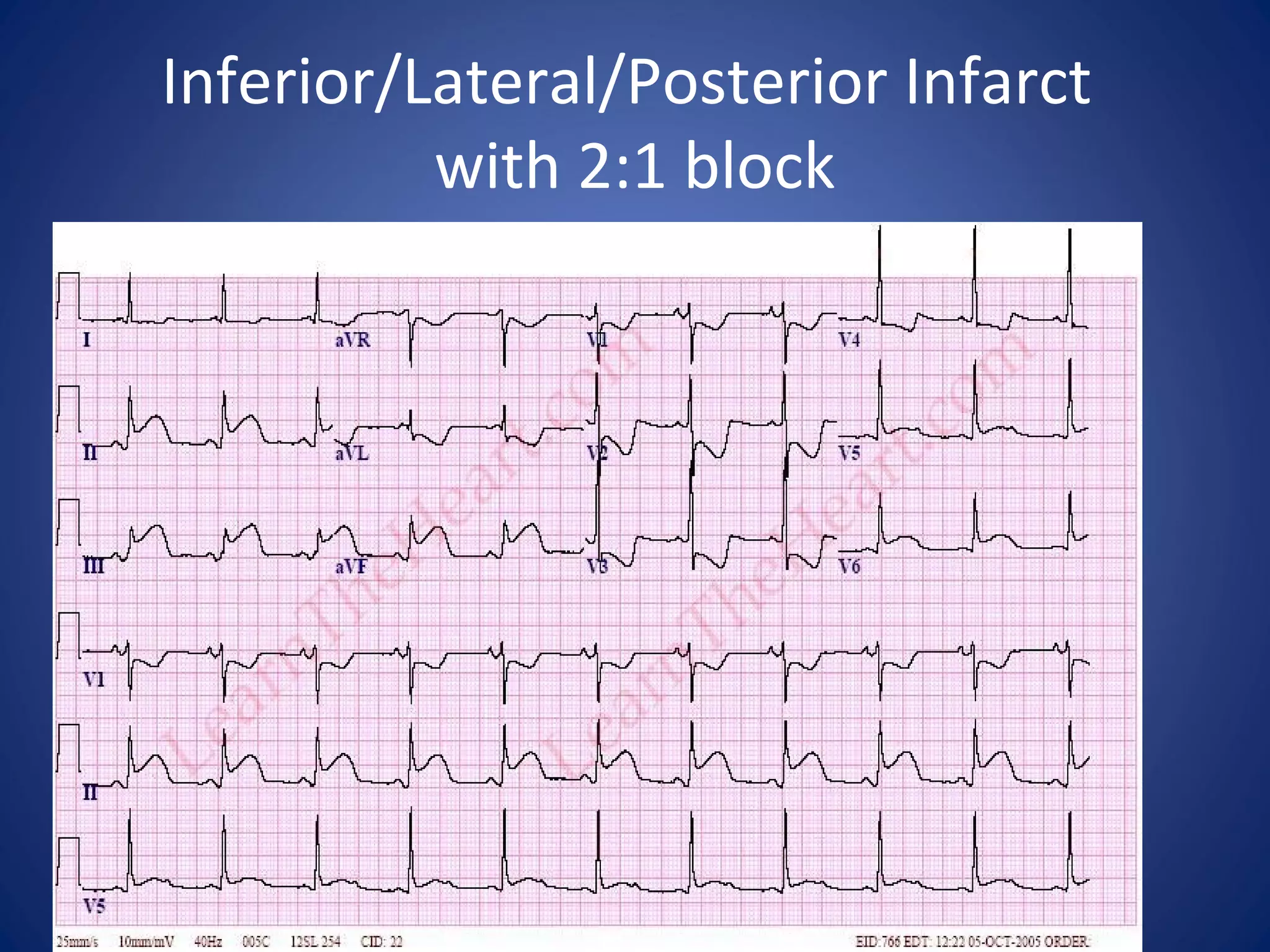 Inferior/Lateral/Posterior Infarct
with 2:1 block
 