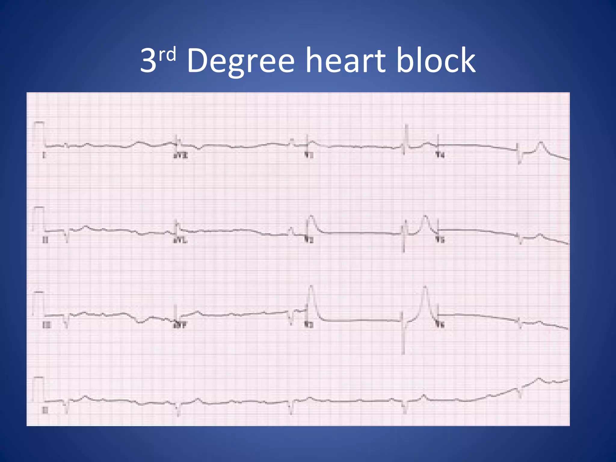 3rd
Degree heart block
 