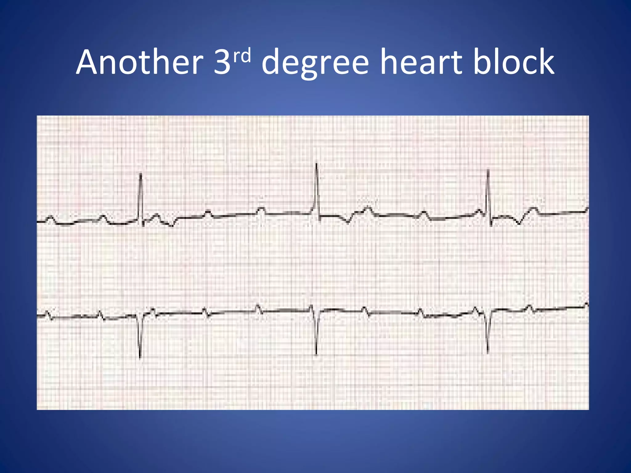 Another 3rd
degree heart block
 