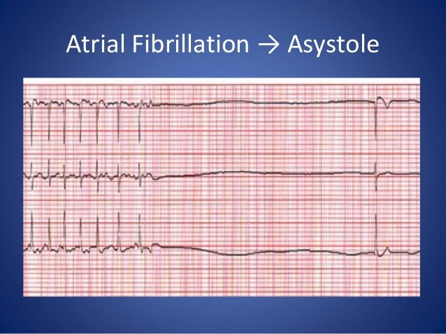 Single chamber pacemaker atrial fibrillation