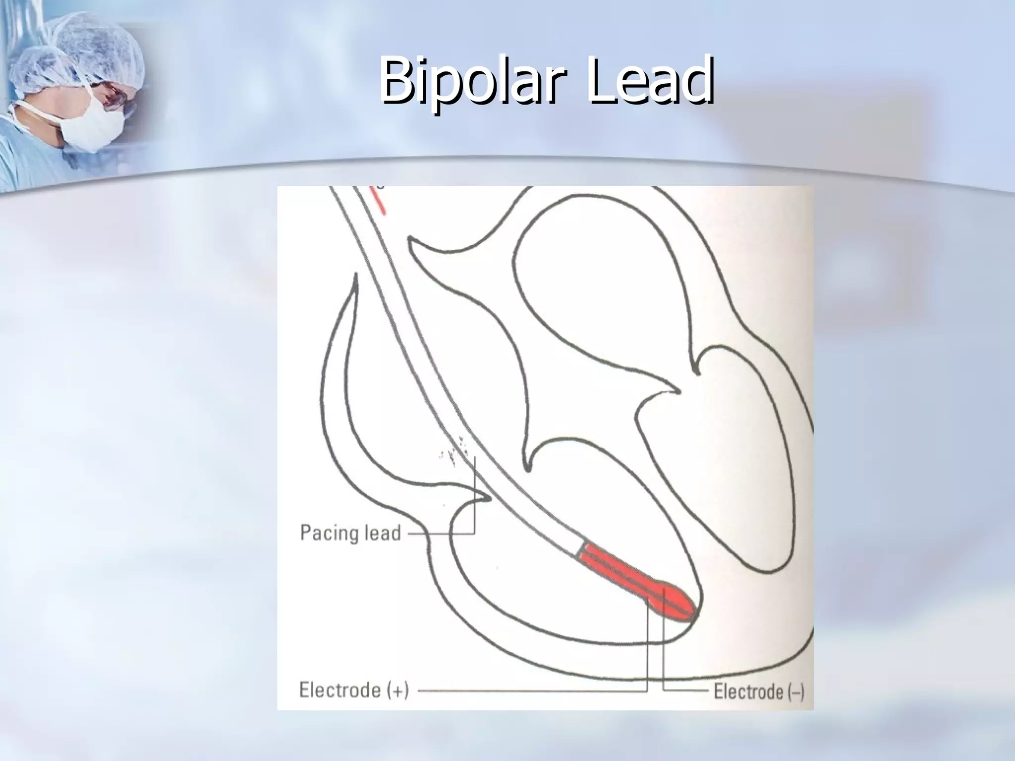 Bipolar Lead 
