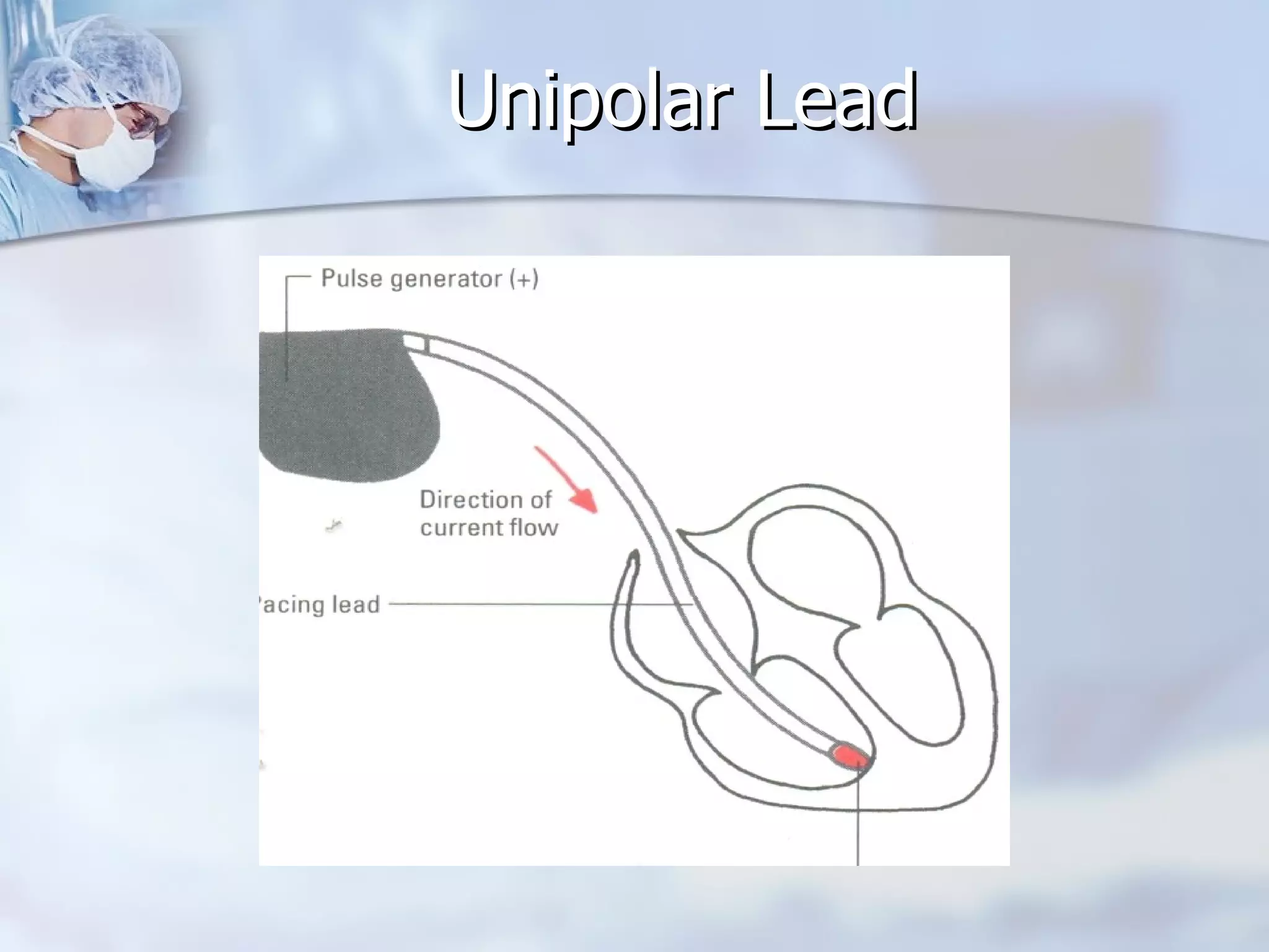 Unipolar Lead 