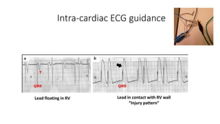 Intra-cardiac ECG guidance
Lead floating in RV Lead in contact with RV wall
“Injury pattern”
 