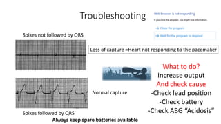 Troubleshooting
Spikes not followed by QRS
Spikes followed by QRS
Loss of capture =Heart not responding to the pacemaker
Normal capture
What to do?
Increase output
And check cause
-Check lead position
-Check battery
-Check ABG “Acidosis”
Always keep spare batteries available
 