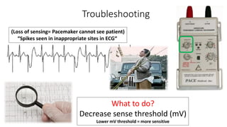 Troubleshooting
(Loss of sensing= Pacemaker cannot see patient)
“Spikes seen in inappropriate sites in ECG“
What to do?
Decrease sense threshold (mV)
Lower mV threshold = more sensitive
 