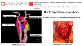 3D MSCT back view
The 3rd reported case worldwide
Bilateral absent SVC with complete heart block
Epicardial permanent pacemaker
 