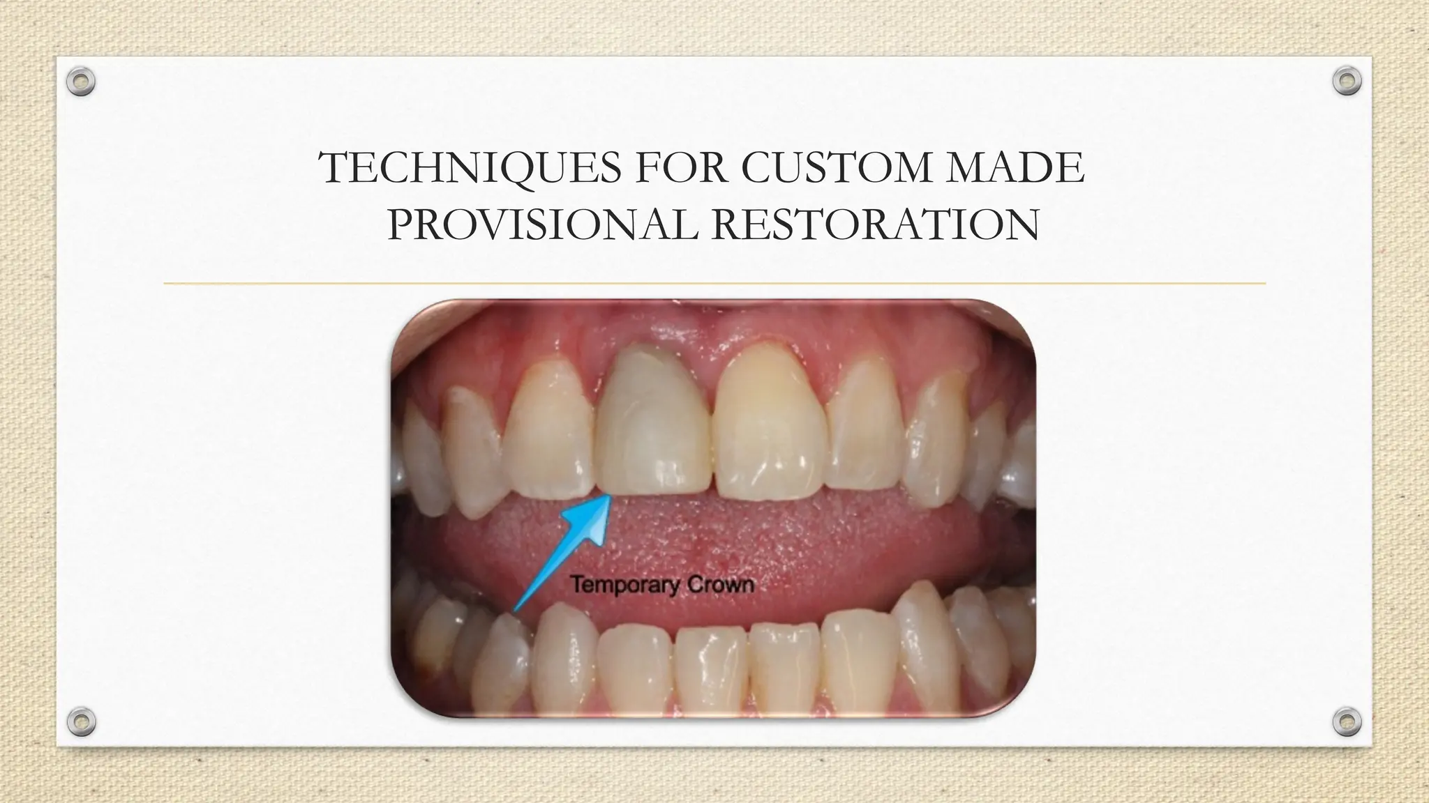 TECHNIQUES FOR CUSTOM MADE
PROVISIONAL RESTORATION
 