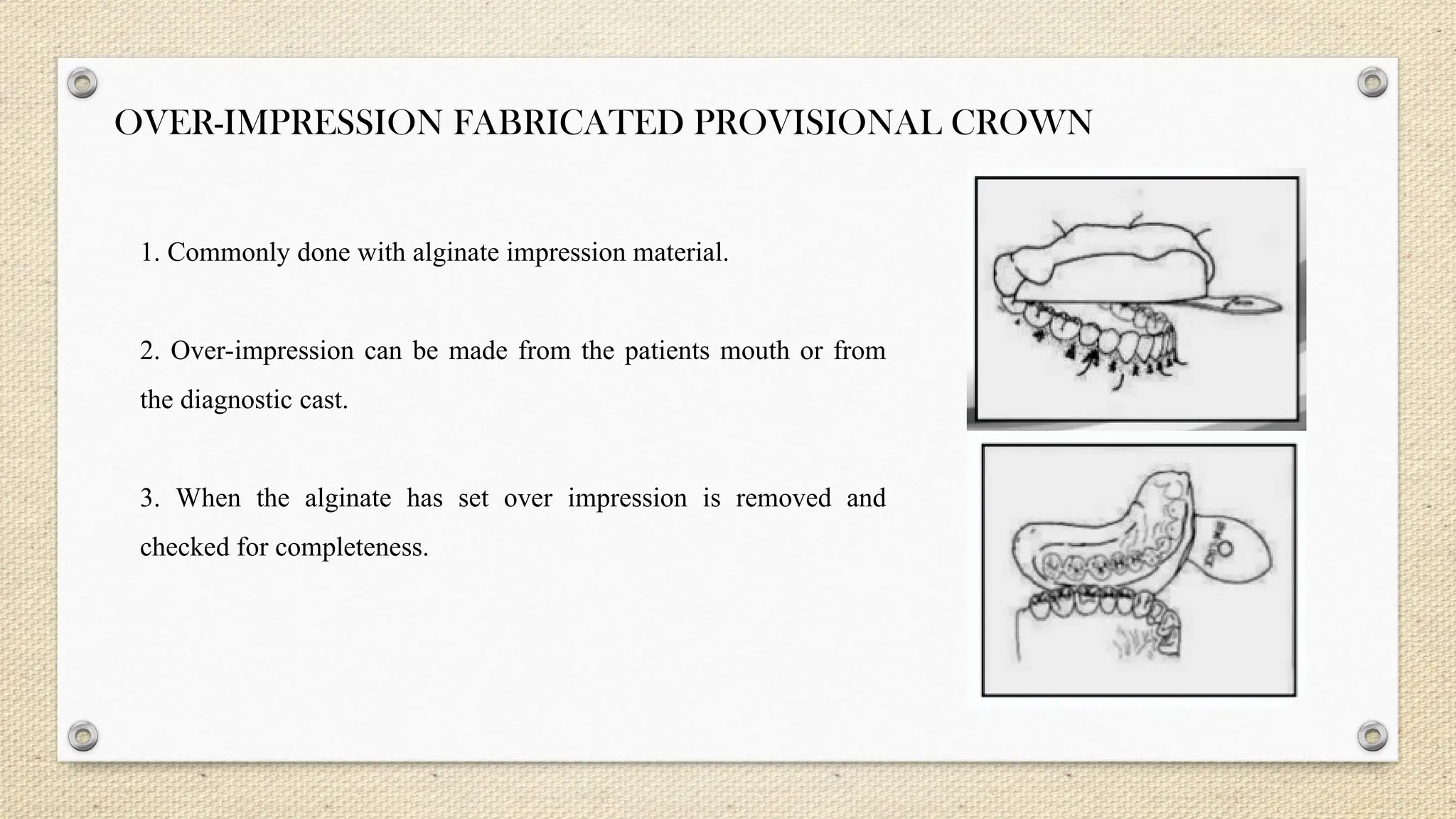 OVER-IMPRESSION FABRICATED PROVISIONAL CROWN
1. Commonly done with alginate impression material.
2. Over-impression can be made from the patients mouth or from
the diagnostic cast.
3. When the alginate has set over impression is removed and
checked for completeness.
 