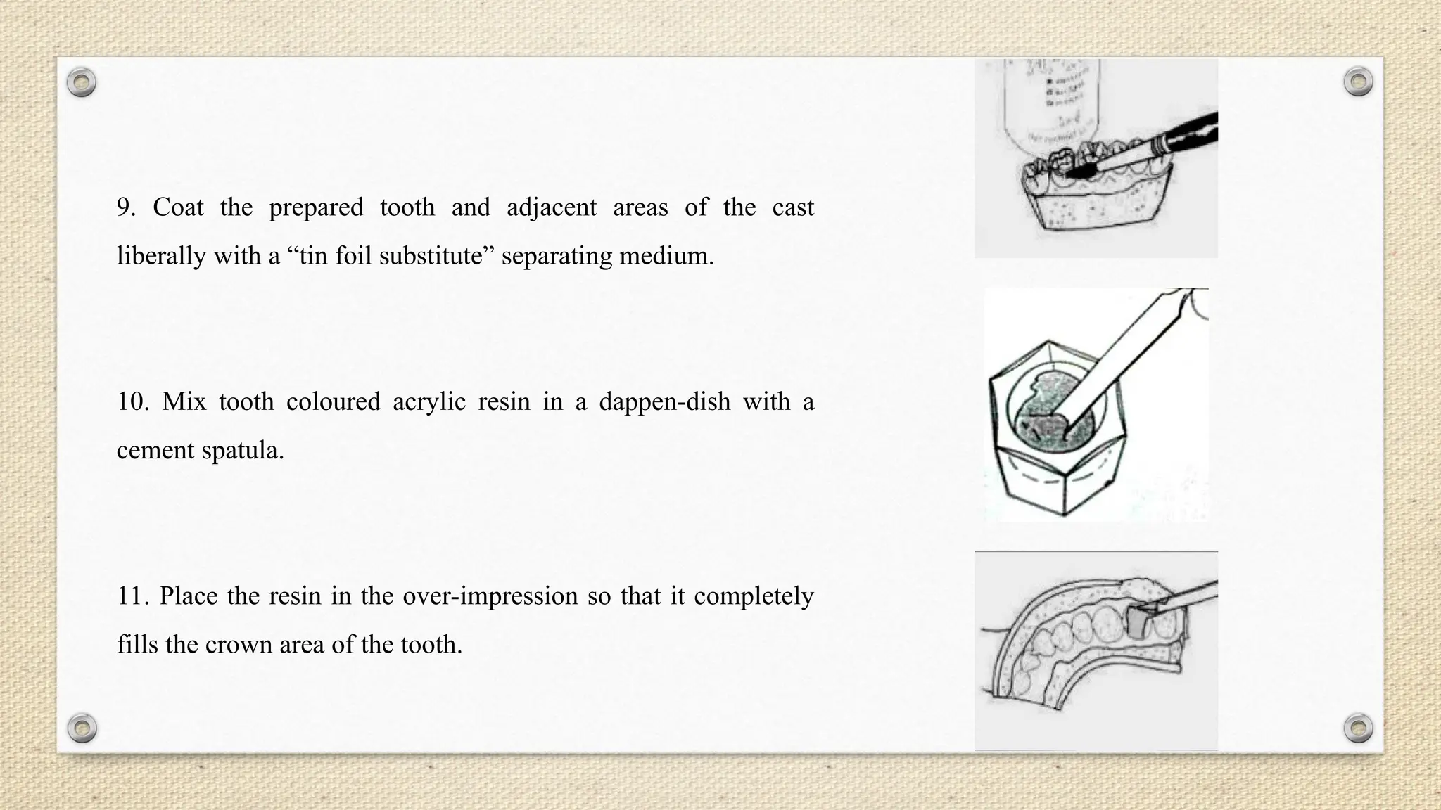 9. Coat the prepared tooth and adjacent areas of the cast
liberally with a “tin foil substitute” separating medium.
10. Mix tooth coloured acrylic resin in a dappen-dish with a
cement spatula.
11. Place the resin in the over-impression so that it completely
fills the crown area of the tooth.
 