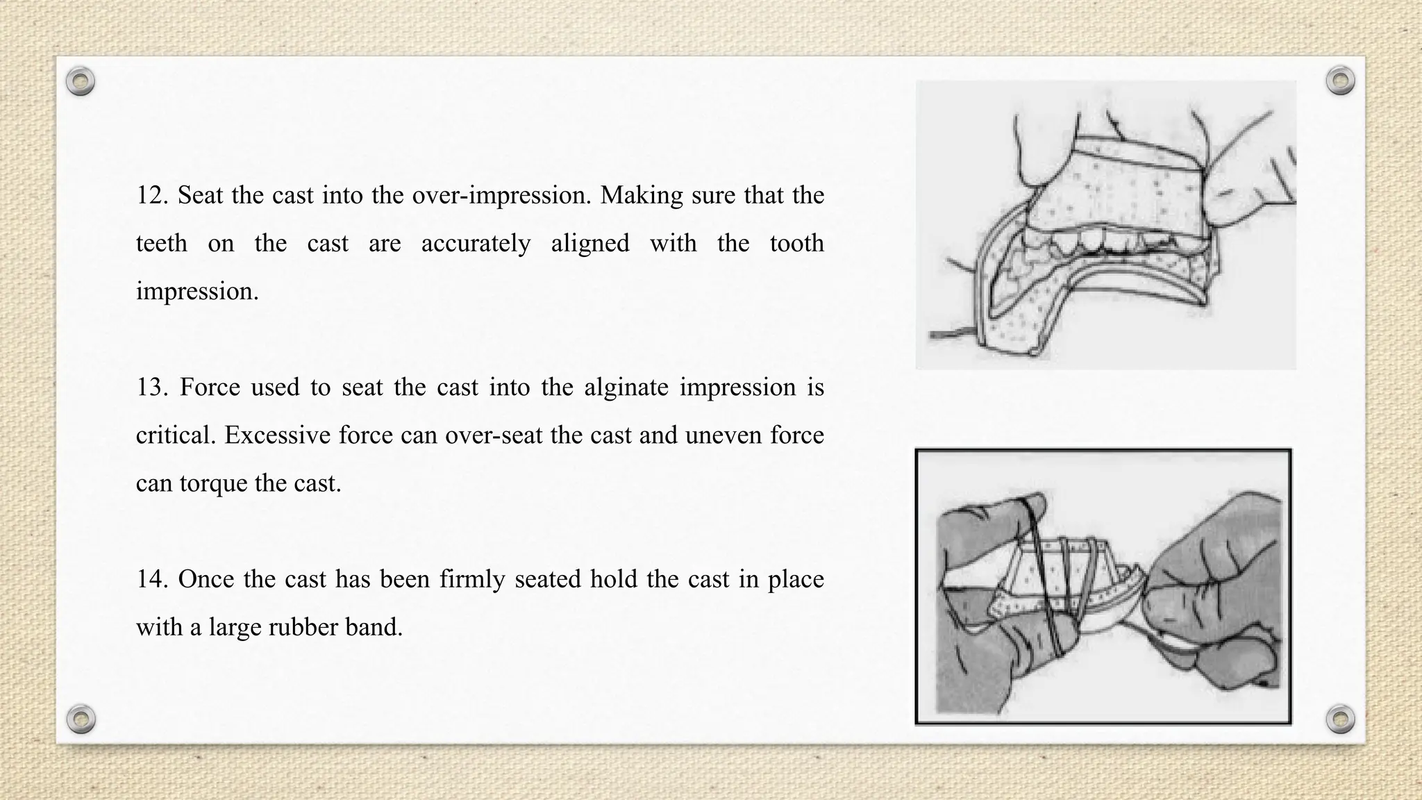 12. Seat the cast into the over-impression. Making sure that the
teeth on the cast are accurately aligned with the tooth
impression.
13. Force used to seat the cast into the alginate impression is
critical. Excessive force can over-seat the cast and uneven force
can torque the cast.
14. Once the cast has been firmly seated hold the cast in place
with a large rubber band.
 