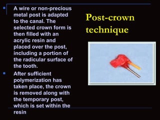    A wire or non-precious
    metal post is adapted
    to the canal. The          Post-crown
    selected crown form is
    then filled with an
                               technique
    acrylic resin and
    placed over the post,
    including a portion of
    the radicular surface of
    the tooth.
   After sufficient
    polymerization has
    taken place, the crown
    is removed along with
    the temporary post,
    which is set within the
    resin
 
