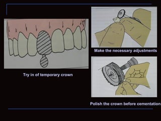 Make the necessary adjustments




Try in of temporary crown




                            Polish the crown before cementation
 