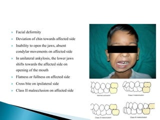 Temporomandibular joint ankylosis | PPTX