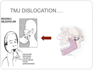 TMJ DISLOCATION….
 