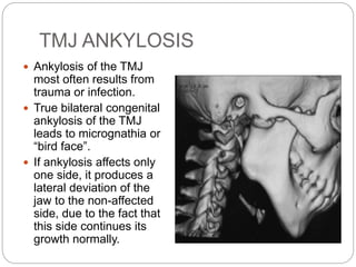 TMJ ANKYLOSIS
 Ankylosis of the TMJ
most often results from
trauma or infection.
 True bilateral congenital
ankylosis of the TMJ
leads to micrognathia or
“bird face”.
 If ankylosis affects only
one side, it produces a
lateral deviation of the
jaw to the non-affected
side, due to the fact that
this side continues its
growth normally.
 