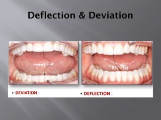 Temporo mandibular joint and its disorders | PPTX