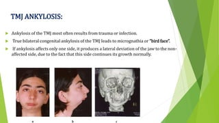 TMJ ANKYLOSIS:
 Ankylosis of the TMJ most often results from trauma or infection.
 True bilateral congenital ankylosis of the TMJ leads to micrognathia or “bird face”.
 If ankylosis affects only one side, it produces a lateral deviation of the jaw to the non-
affected side, due to the fact that this side continues its growth normally.
 