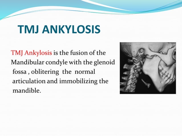 temporomandibular-joint-ankylosis-pptx