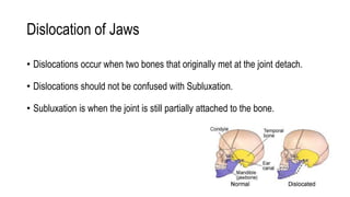 Dislocation of Jaws
• Dislocations occur when two bones that originally met at the joint detach.
• Dislocations should not be confused with Subluxation.
• Subluxation is when the joint is still partially attached to the bone.
 