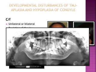 Temporomandibular joint disorders | PPTX